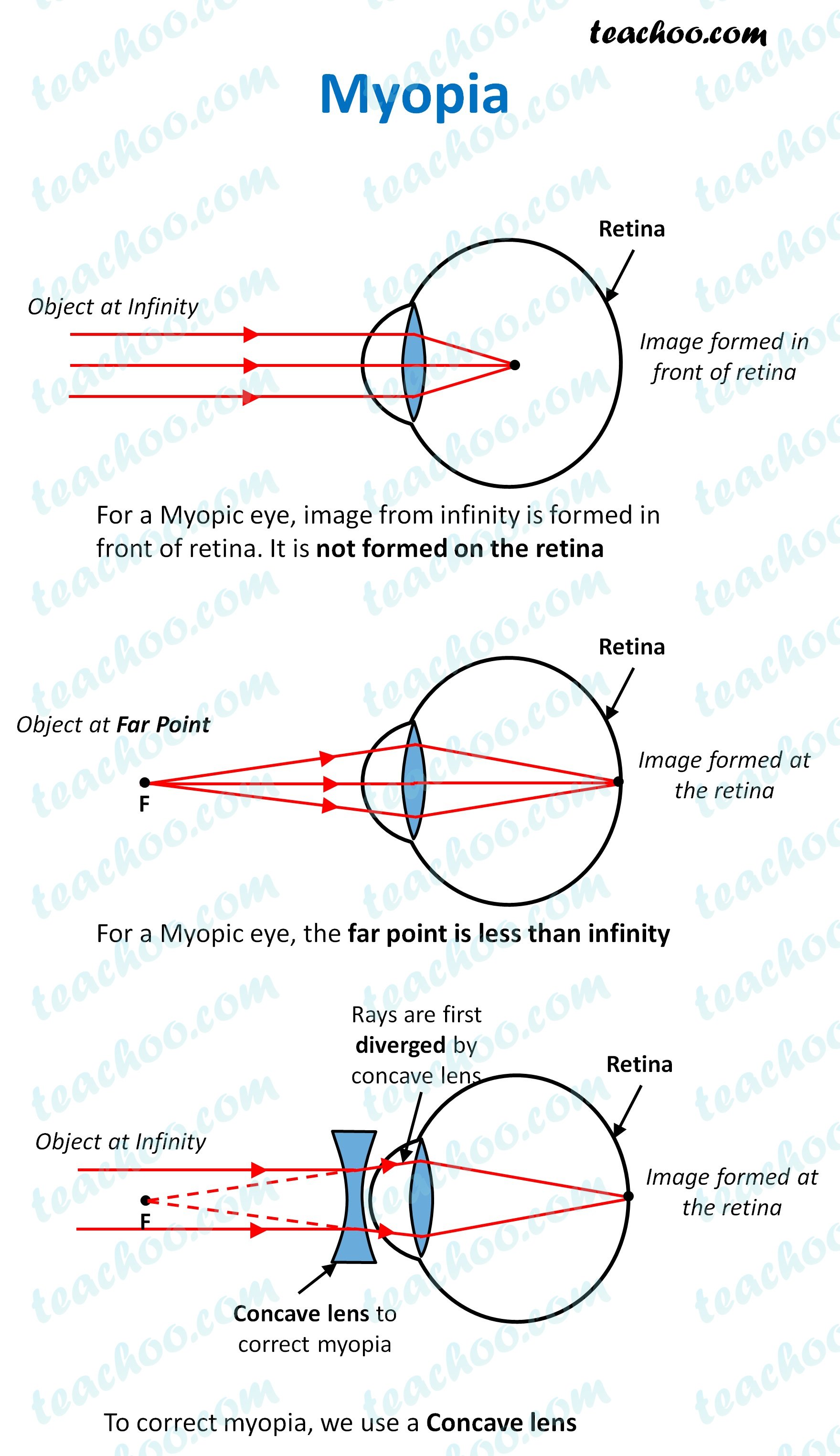 myopia---teachoo.jpg